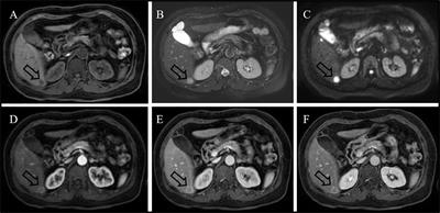 Case Report: A rare case of primary hepatic Castleman’s disease mimicking a liver tumor